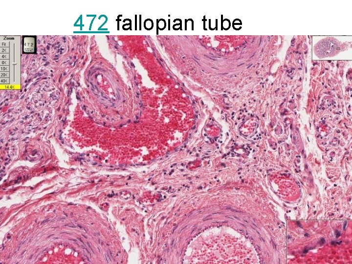 472 fallopian tube 