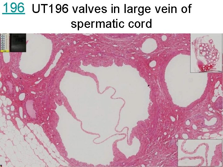 196 UT 196 valves in large vein of spermatic cord 