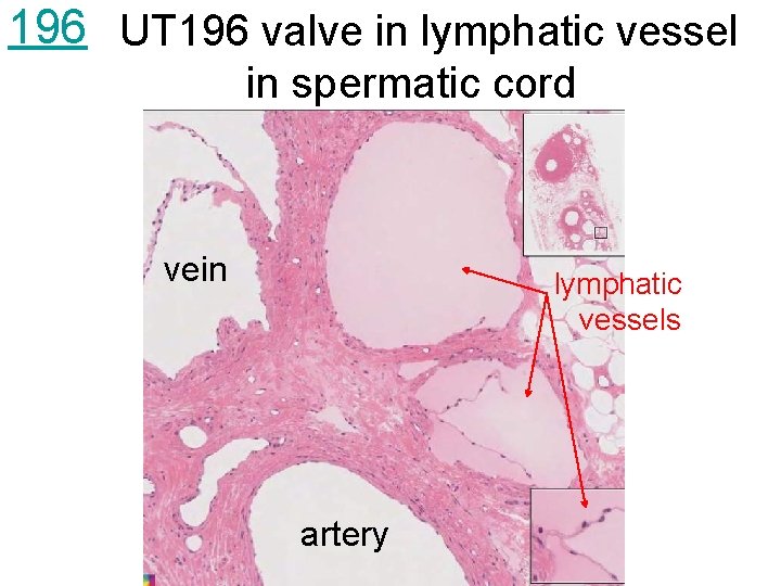 196 UT 196 valve in lymphatic vessel in spermatic cord vein lymphatic vessels artery