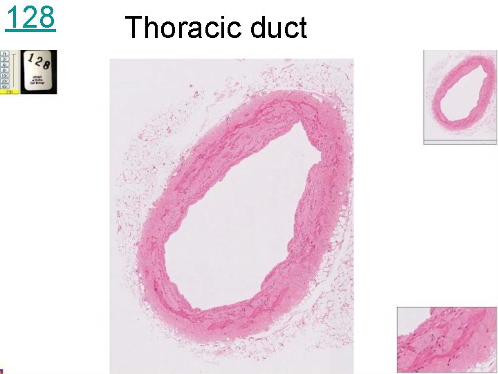 128 Thoracic duct 