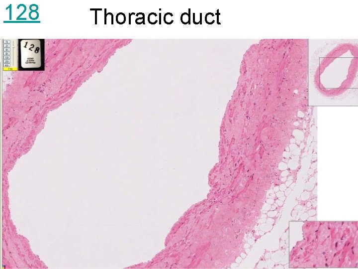 128 Thoracic duct 