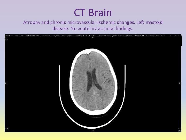 CT Brain Atrophy and chronic microvascular ischemic changes. Left mastoid disease. No acute intracranial