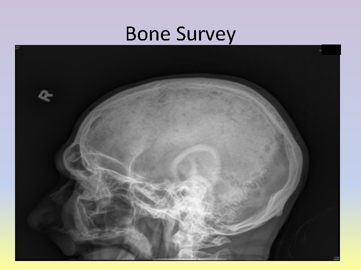 Bone Survey 