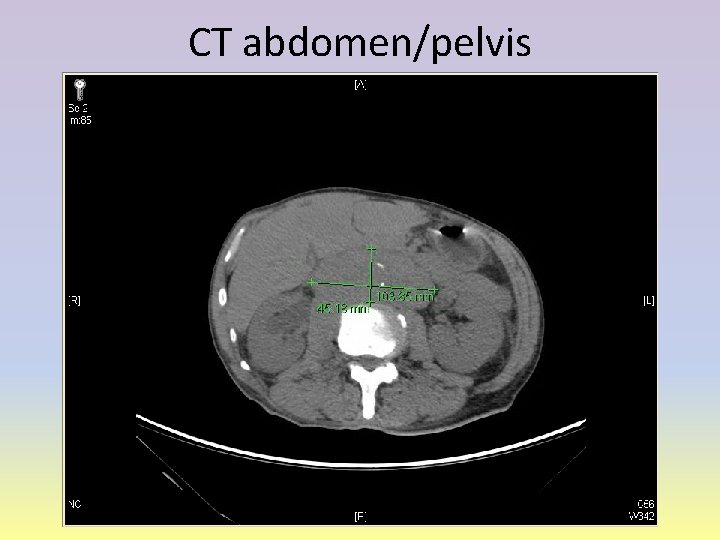 CT abdomen/pelvis 