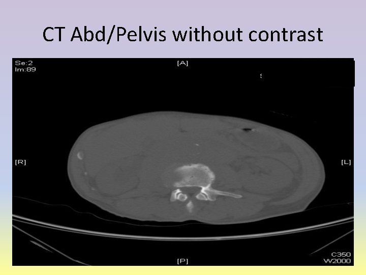 CT Abd/Pelvis without contrast 