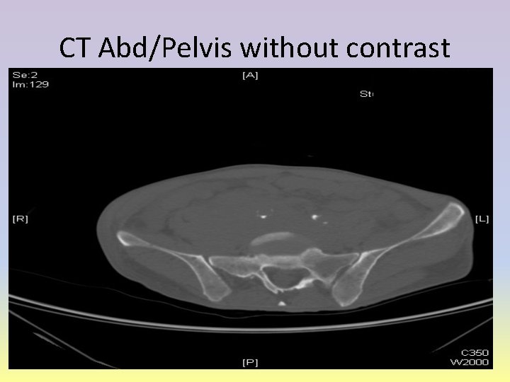 CT Abd/Pelvis without contrast 