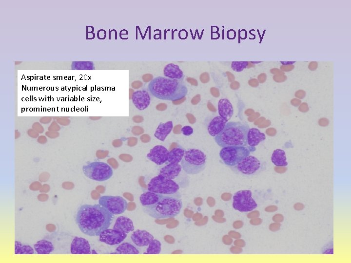 Bone Marrow Biopsy Aspirate smear, 20 x Numerous atypical plasma cells with variable size,