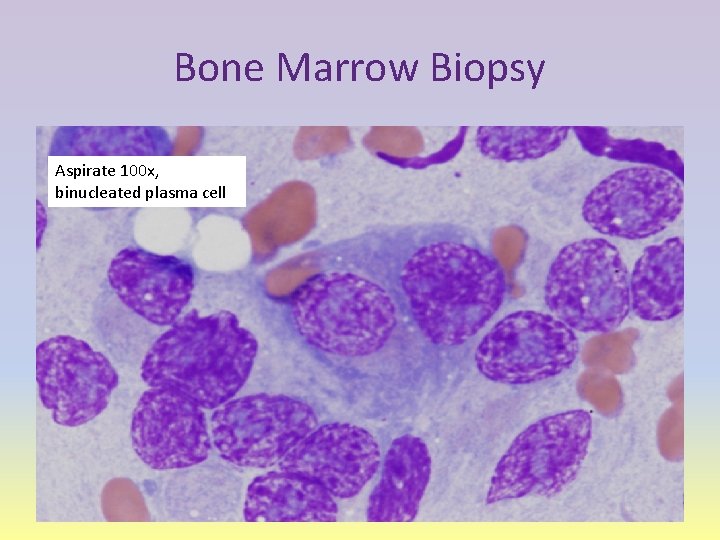 Bone Marrow Biopsy Aspirate 100 x, binucleated plasma cell 