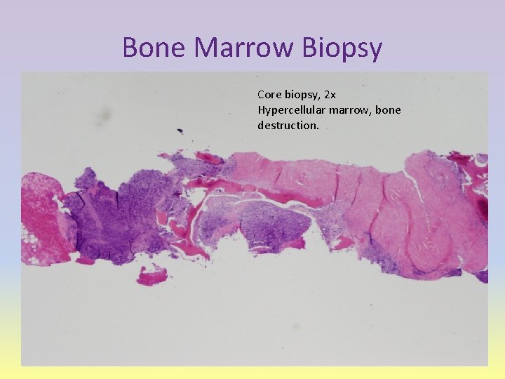 Bone Marrow Biopsy Core biopsy, 2 x Hypercellular marrow, bone destruction. 
