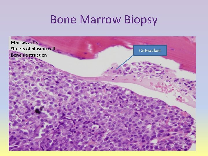 Bone Marrow Biopsy Marrow, 20 x Sheets of plasma cell Bone destruction Osteoclast 