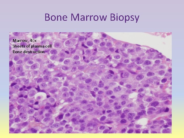 Bone Marrow Biopsy Marrow, 40 x Sheets of plasma cell Bone destruction 