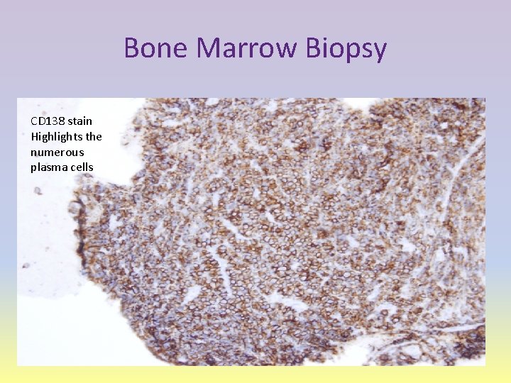 Bone Marrow Biopsy CD 138 stain Highlights the numerous plasma cells 