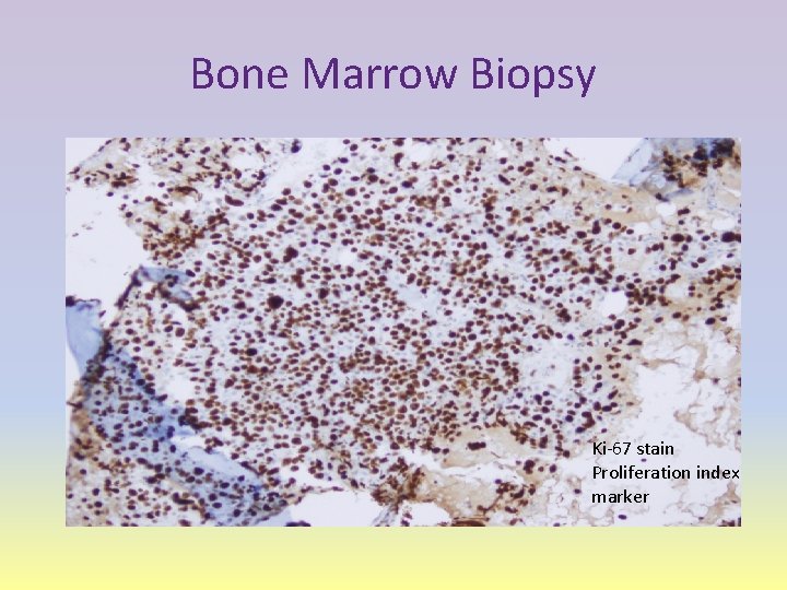Bone Marrow Biopsy Ki-67 stain Proliferation index marker 