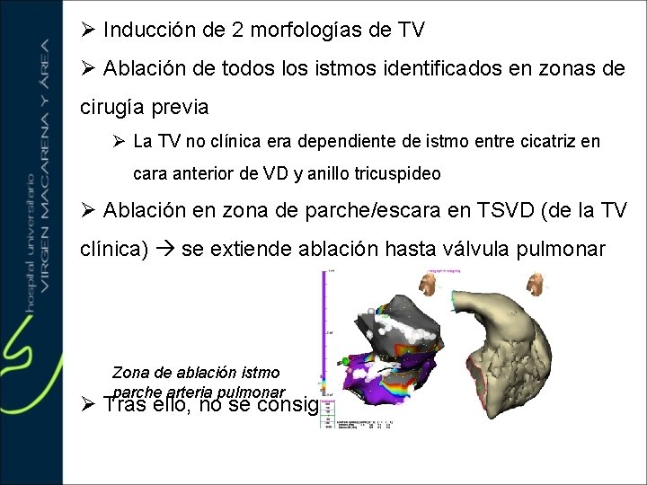 Ø Inducción de 2 morfologías de TV Ø Ablación de todos los istmos identificados