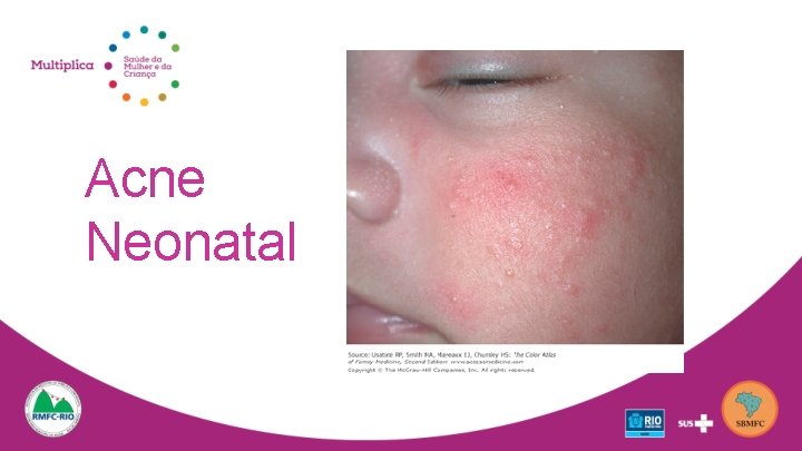 Acne Neonatal 