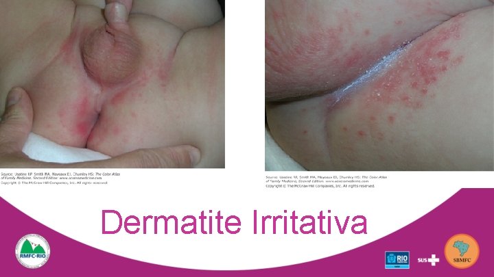 Dermatite Irritativa 