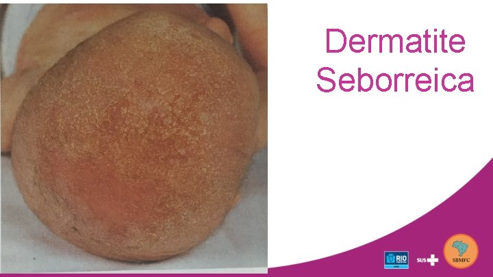 Dermatite Seborreica 