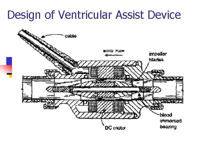 Design of Ventricular Assist Device 
