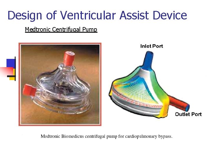Design of Ventricular Assist Device Medtronic Centrifugal Pump 