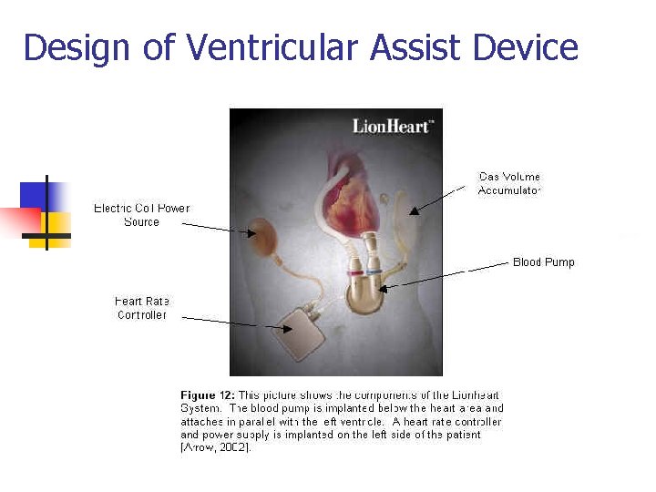 Design of Ventricular Assist Device 