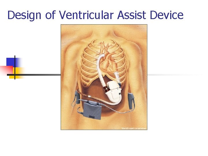 Design of Ventricular Assist Device 