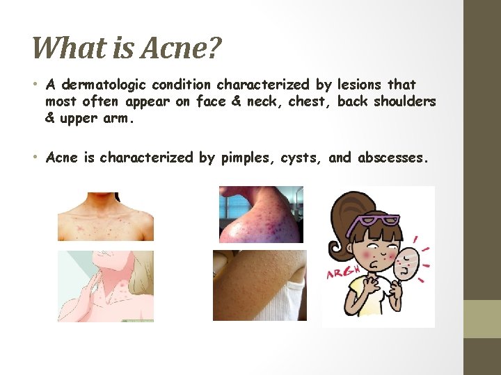 What is Acne? • A dermatologic condition characterized by lesions that most often appear