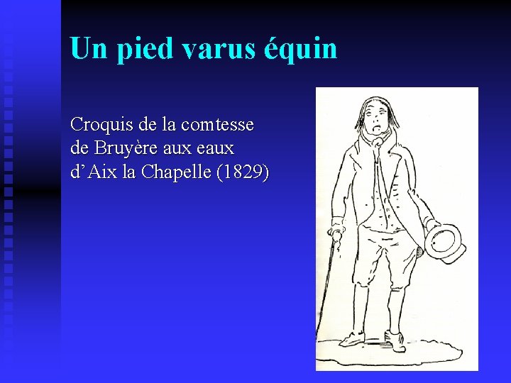 Un pied varus équin Croquis de la comtesse de Bruyère aux eaux d’Aix la