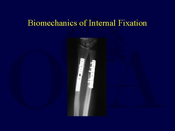 Biomechanics of Internal Fixation 