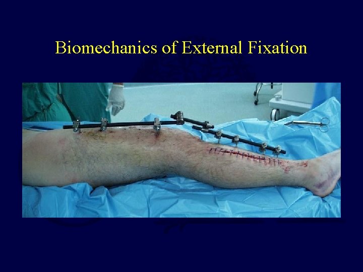 Biomechanics of External Fixation 