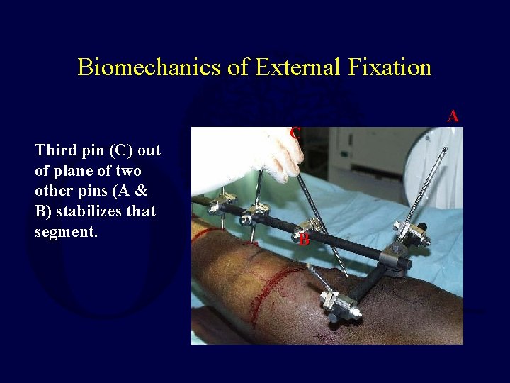 Biomechanics of External Fixation Third pin (C) out of plane of two other pins