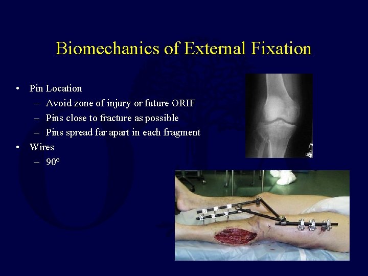 Biomechanics of External Fixation • Pin Location – Avoid zone of injury or future