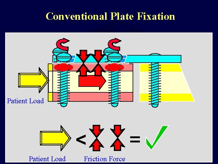Conventional Plate Fixation Patient Load < Patient Load Friction Force = 