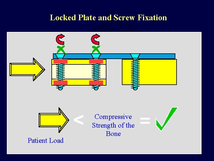 Locked Plate and Screw Fixation < Patient Load Compressive Strength of the Bone =