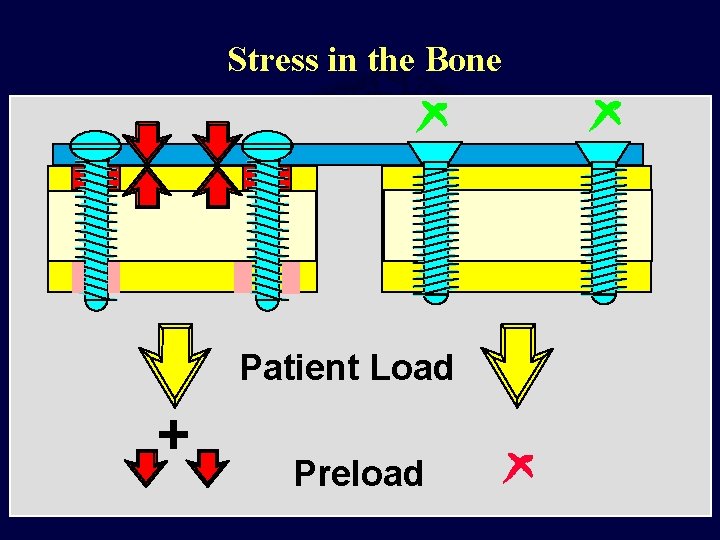 Stress in the Bone Patient Load + Preload 