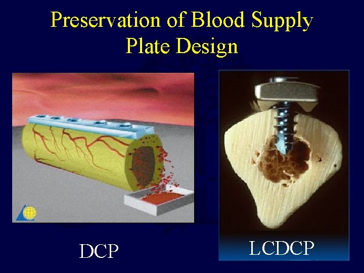 Preservation of Blood Supply Plate Design DCP LCDCP 