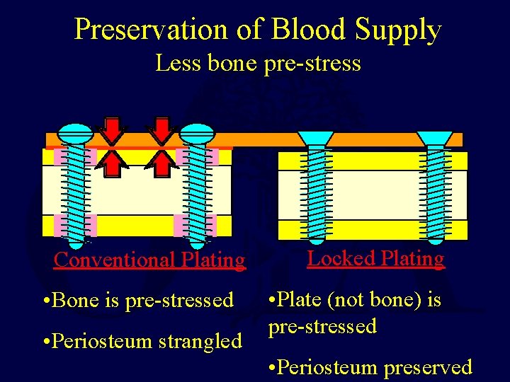 Preservation of Blood Supply Less bone pre-stress Conventional Plating • Bone is pre-stressed •