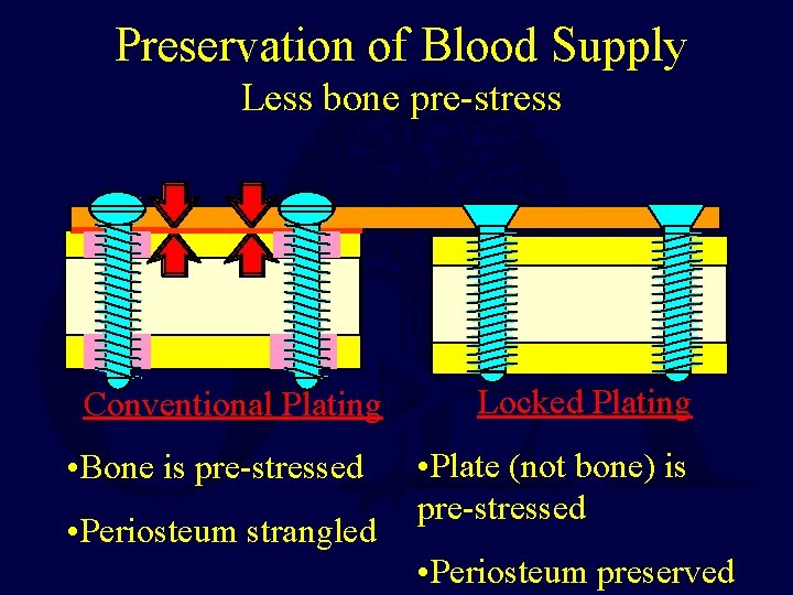 Preservation of Blood Supply Less bone pre-stress Conventional Plating • Bone is pre-stressed • Preservation of Blood Supply Less bone pre-stress Conventional Plating • Bone is pre-stressed •