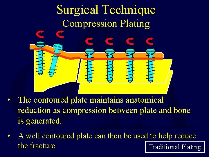 Surgical Technique Compression Plating • The contoured plate maintains anatomical reduction as compression between