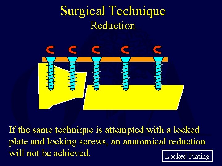Surgical Technique Reduction If the same technique is attempted with a locked plate and