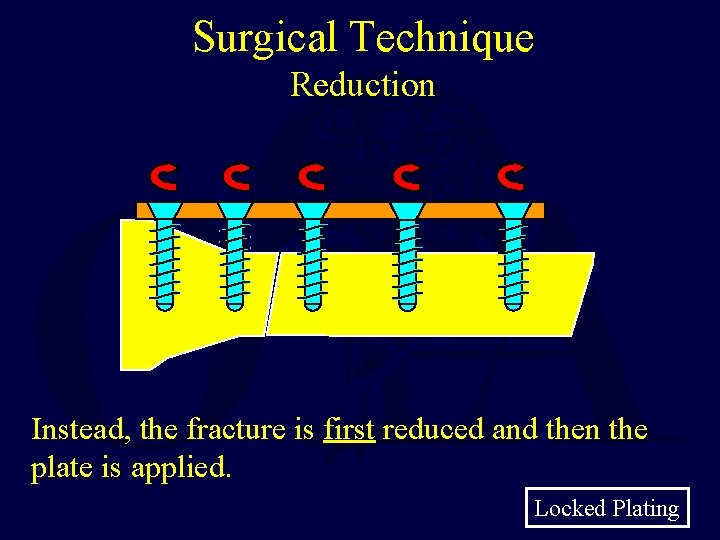 Surgical Technique Reduction Instead, the fracture is first reduced and then the plate is