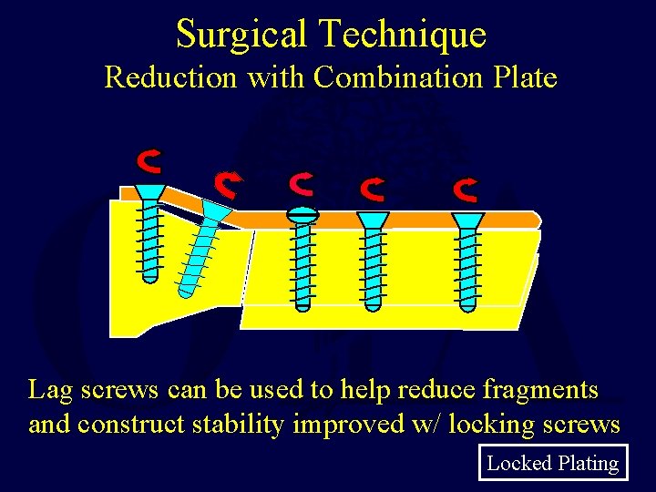 Surgical Technique Reduction with Combination Plate Lag screws can be used to help reduce Surgical Technique Reduction with Combination Plate Lag screws can be used to help reduce