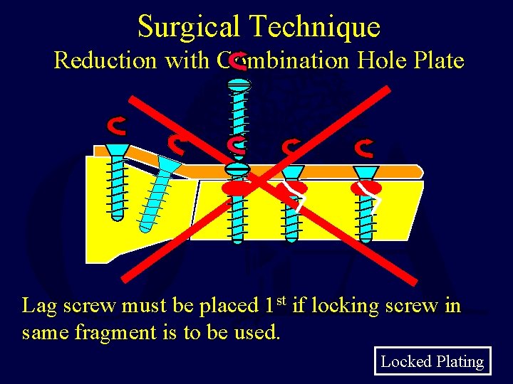Surgical Technique Reduction with Combination Hole Plate Lag screw must be placed 1 st