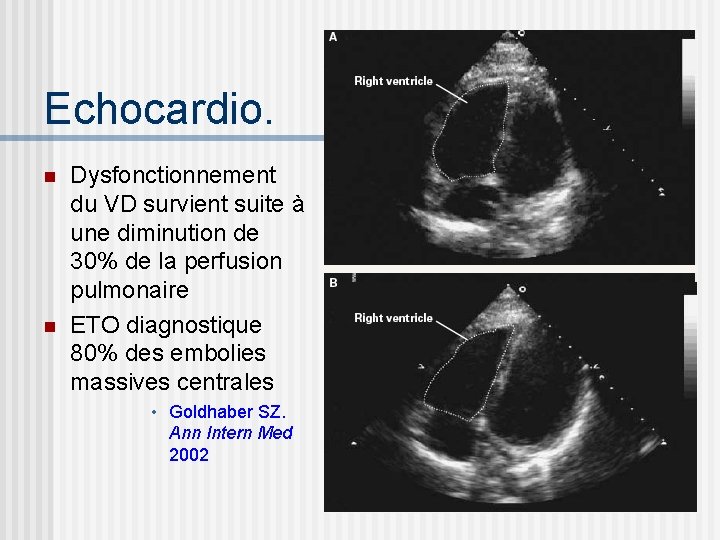 Echocardio. n n Dysfonctionnement du VD survient suite à une diminution de 30% de