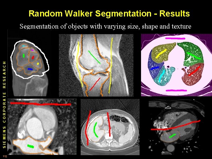 Random Walker Segmentation - Results SIEMENS CORPORATE RESEARCH Segmentation of objects with varying size,