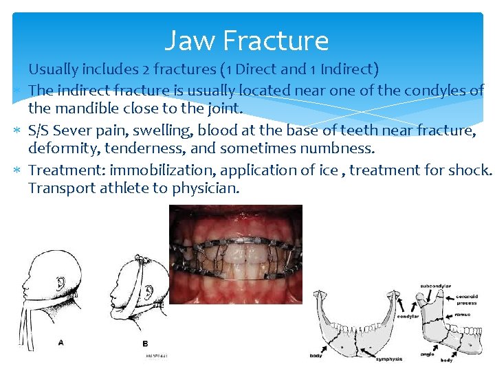 Jaw Fracture Usually includes 2 fractures (1 Direct and 1 Indirect) The indirect fracture