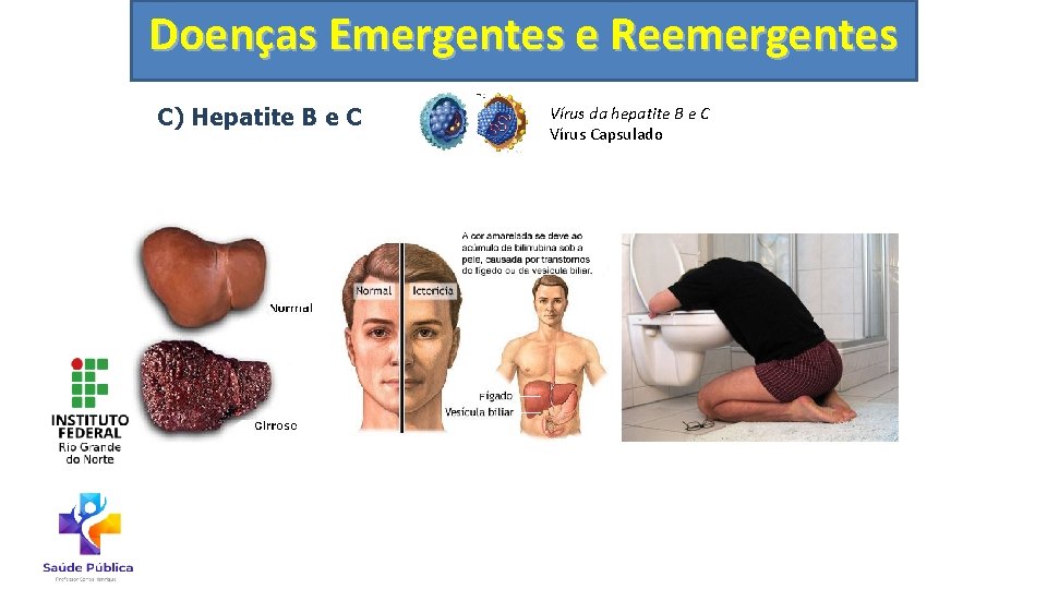 Doenças Emergentes e Reemergentes C) Hepatite B e C Vírus da hepatite B e