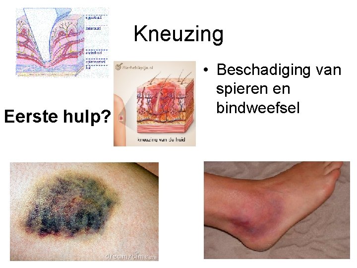 Kneuzing Eerste hulp? • Beschadiging van spieren en bindweefsel 