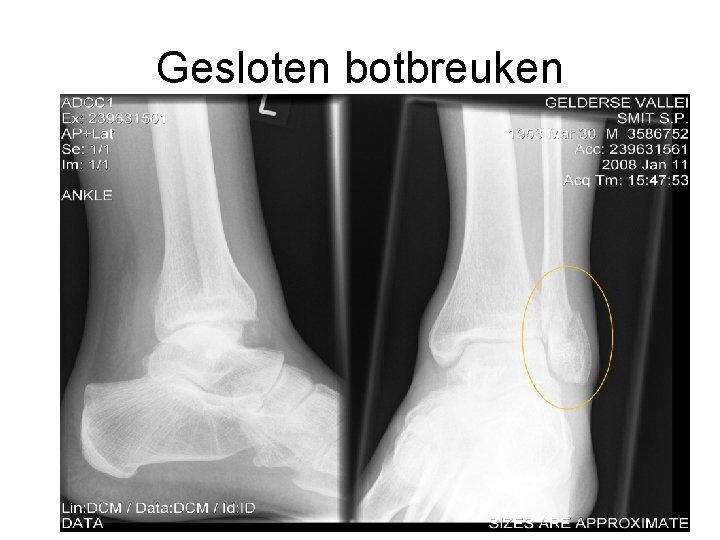 Gesloten botbreuken 