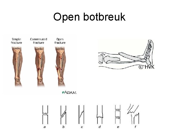 Open botbreuk 