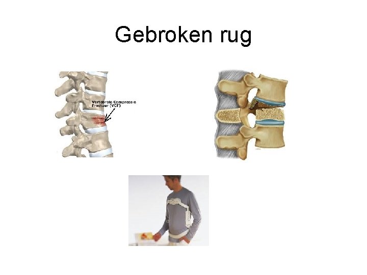 Gebroken rug 